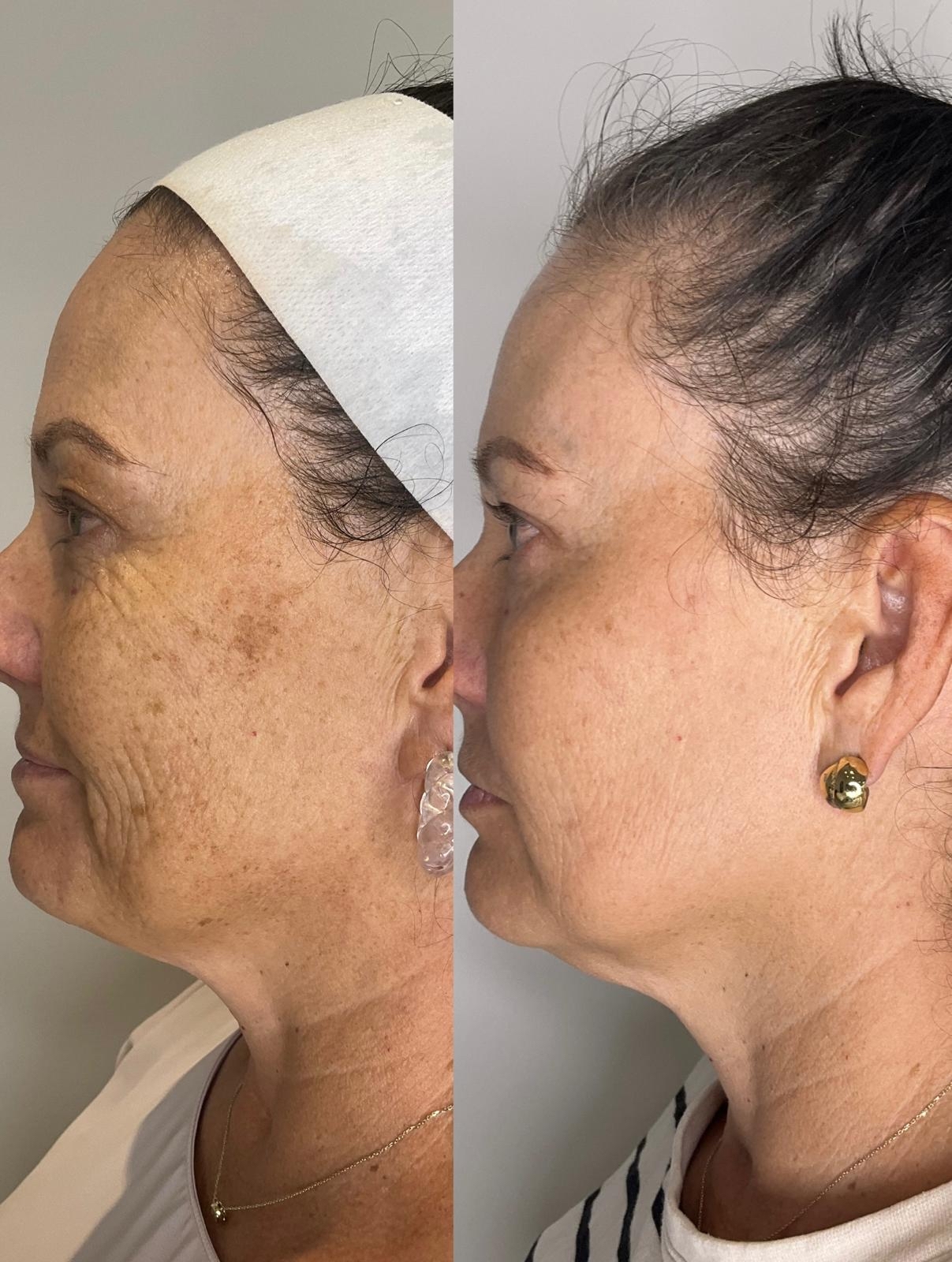 Pigmentation & Sun Damage before and after result