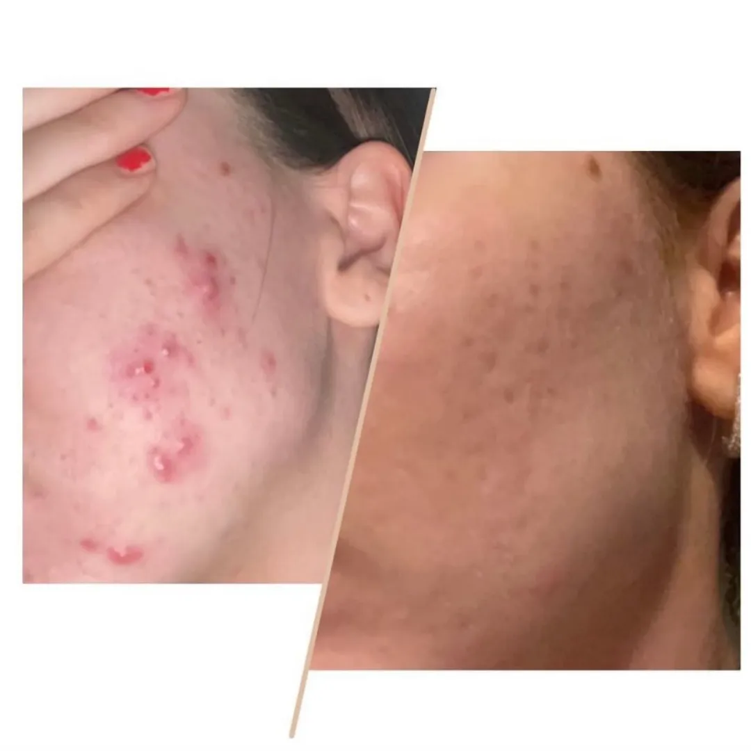 Visibly clearer, smoother skin